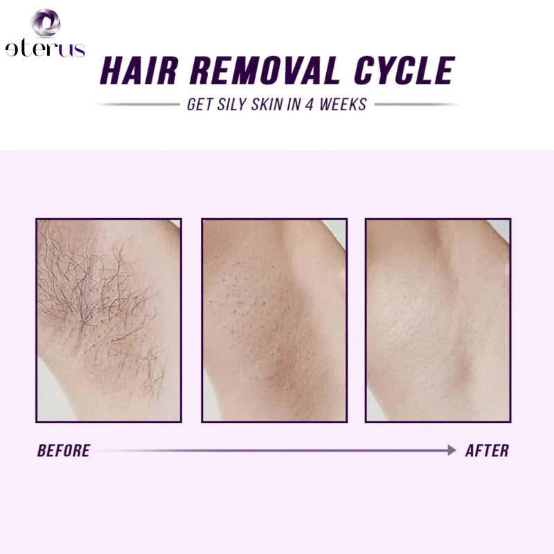 Laser IPL Hair Removal